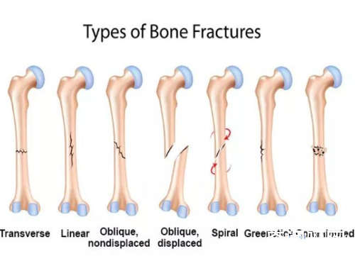 骨折的原因